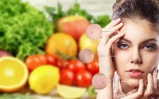 Akne Diyeti: Sağlıklı ve Parlak Bir Cilt İçin Beslenme Rehberi