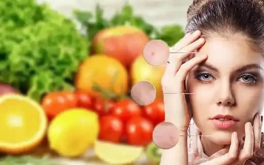 Akne Diyeti: Sağlıklı ve Parlak Bir Cilt İçin Beslenme Rehberi