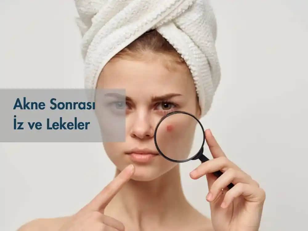 Akne Lekeleri ve Gelişmiş Çözüm Yöntemleriyle Cilt Sağlığını Koruma Rehberi