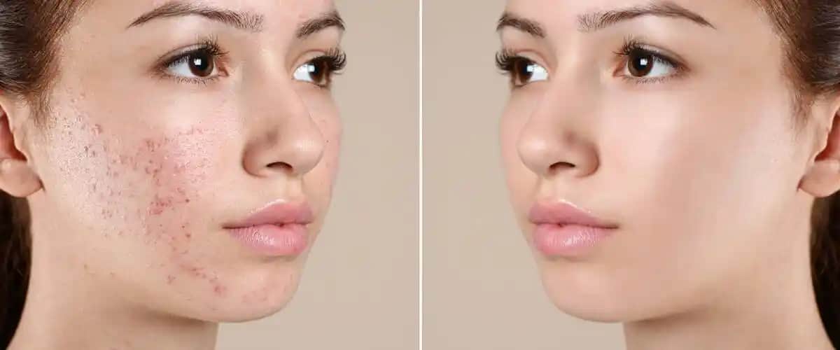 Akne Tedavisinde Güncel Yaklaşımlar ve Kozmetik Dünyasının Rolü Analizi