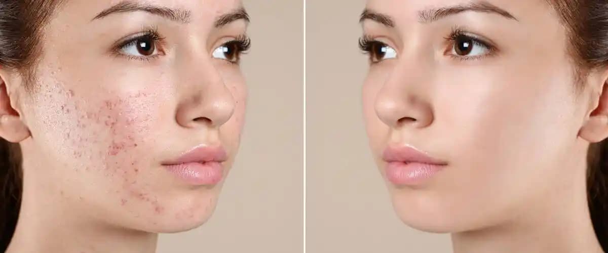 Akne Tedavisinde Güncel Yaklaşımlar ve Kozmetik Dünyasının Rolü Analizi