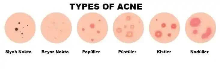 Akne Türleri ve Tedavi Yaklaşımları: Cilt Sağlığınız İçin Bilmeniz Gerekenler