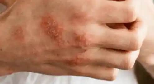 Alerjik Egzama Belirtileri ve Doğru Cilt Bakımı Yöntemleri Hakkında Bilgi