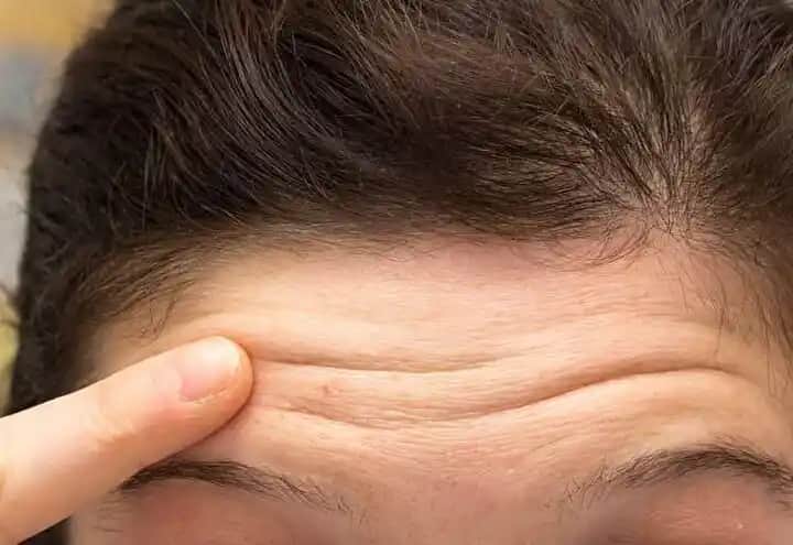 Alın Kırışıklıklarının Nedenleri ve Güncel Tedavi Yöntemleri Hakkında Detaylı Bilgi