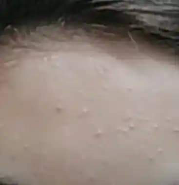 Alnında Küçük Sivilceler: Nedenleri ve Etkili Çözüm Yolları Hakkında Detaylı Bilgi