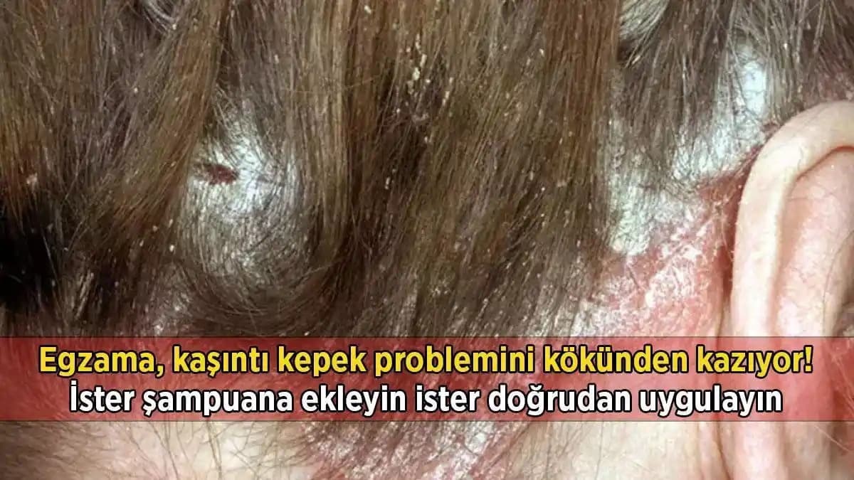 Aşırı Kepek ve Kaşıntı Problemleri İçin Doğru Bakım ve Kozmetik Çözümler