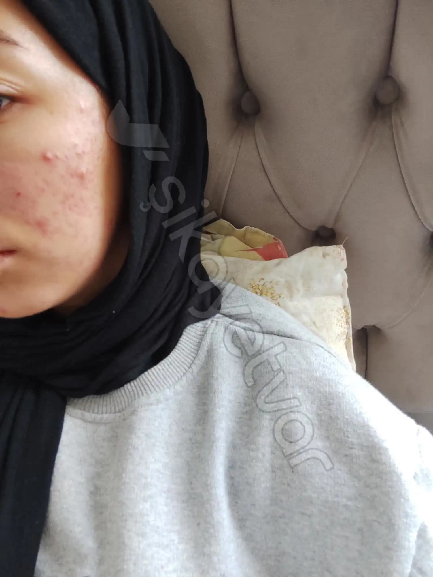 Aşırı Sivilcelenme Nedenleri ve Etkili Cilt Bakım Yöntemleri Hakkında Bilmeniz Gerekenler