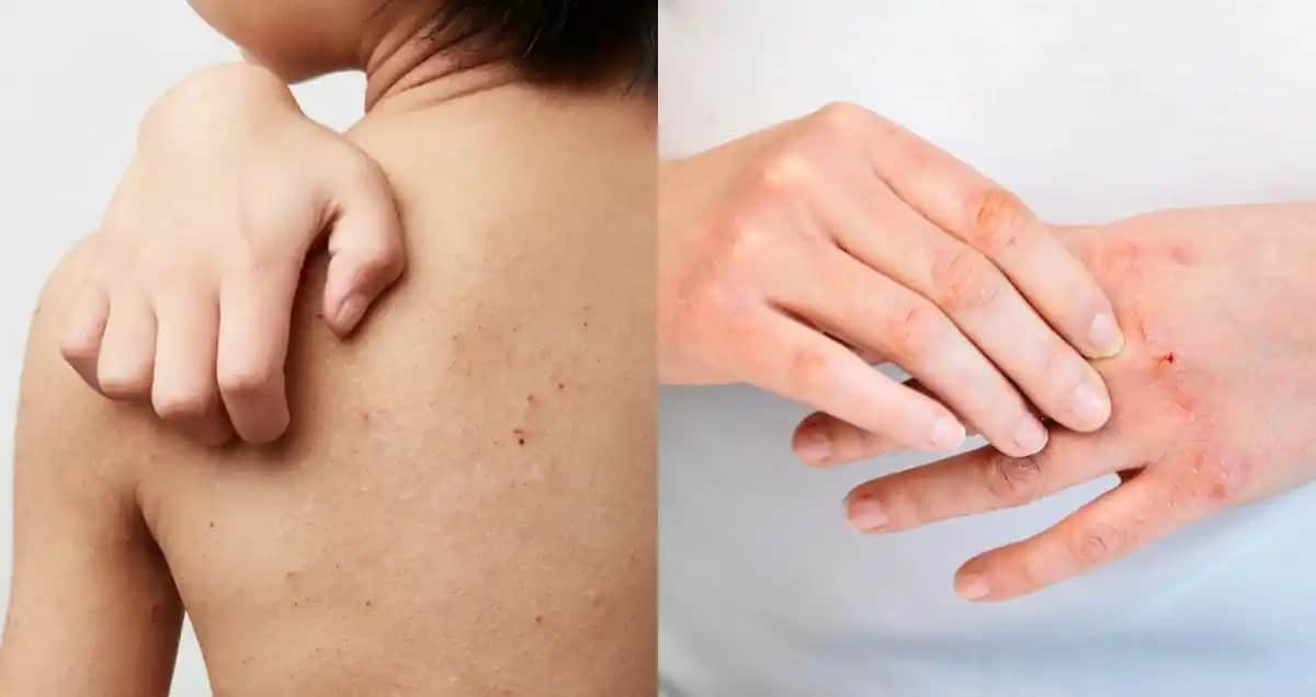 Atopik Cilt Belirtileri ve Doğru Tanı ile Bakım Yöntemleri Rehberi