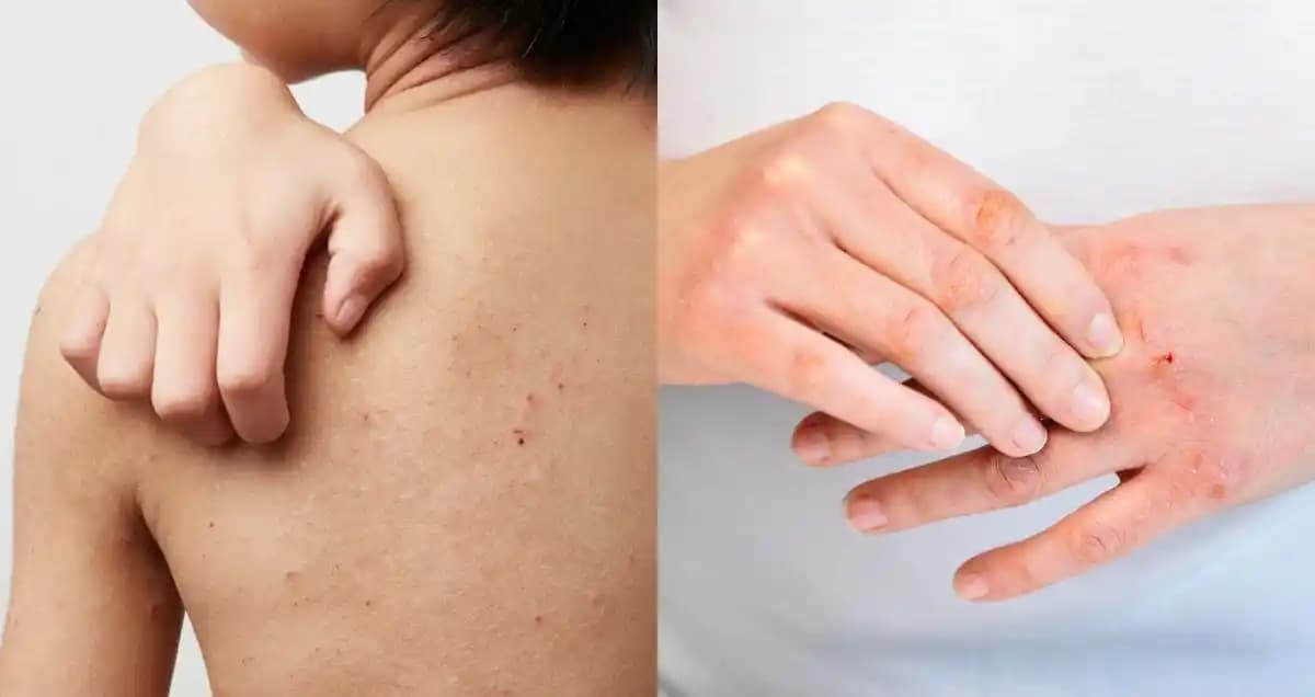 Atopik Cilt Belirtileri ve Doğru Tanı ile Bakım Yöntemleri Rehberi