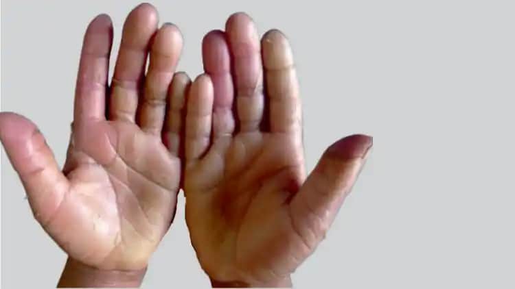 Avuç İçi Soyulmasına Karşı Etkili Cilt Bakım Yöntemleri ve Koruyucu İpuçları