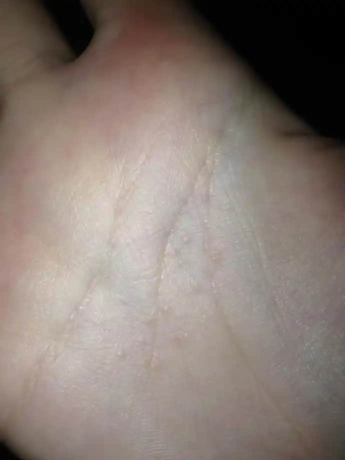 Avuç İçinde Sivilce Nedenleri ve Etkili Tedavi Yöntemleri Hakkında Detaylı Bilgi