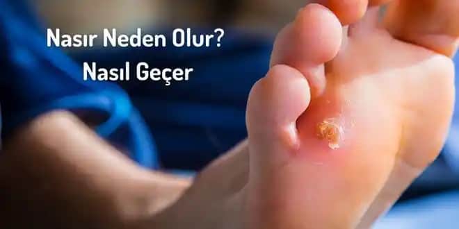 Ayak Altı Nasırı Nasıl Geçer ve Rahatlatıcı Yöntemler Nelerdir