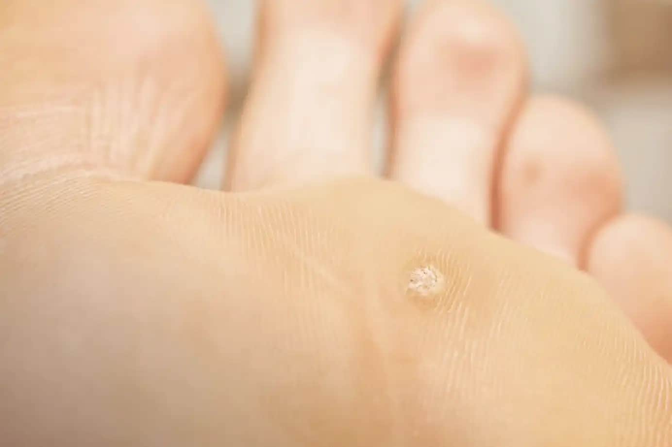 Ayak Altı Sivilcelerine Karşı Etkili Bakım ve Tedavi Yöntemleri