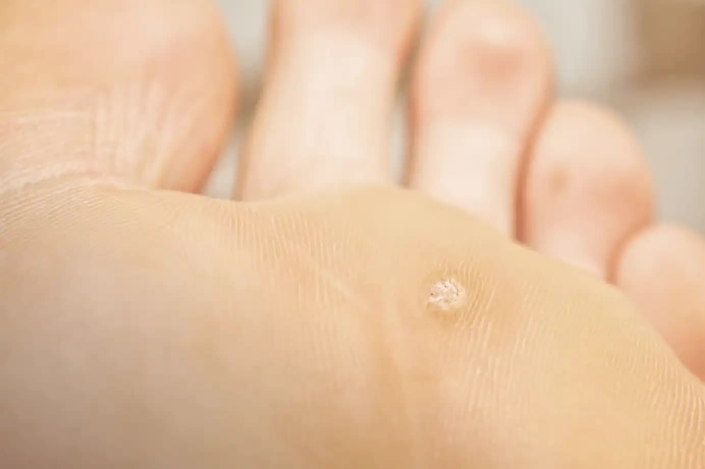 Ayak Altı Sivilcelerine Karşı Etkili Bakım ve Tedavi Yöntemleri