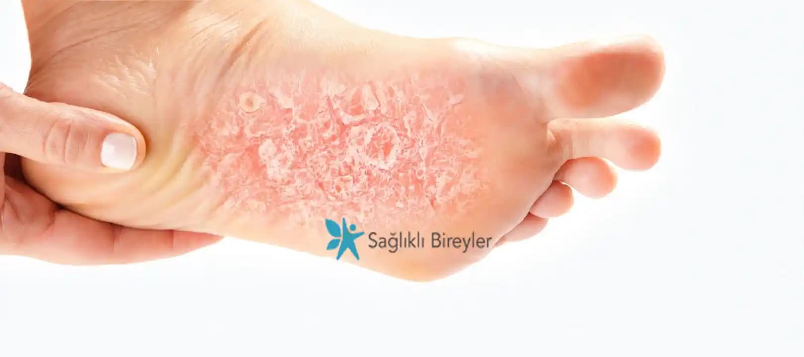 Ayak Altında Egzama Belirtileri ve Uygun Bakım Yöntemleri Hakkında Detaylı Bilgi
