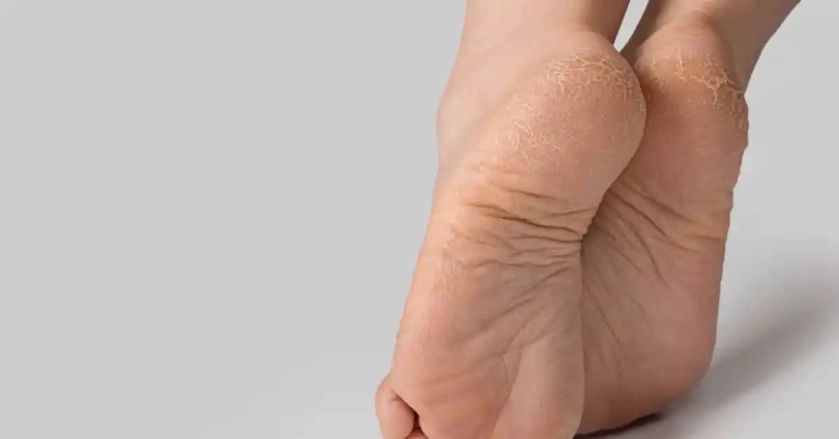 Ayak Çatlamasının Nedenleri, Belirtileri ve Etkili Tedavi Yöntemleri