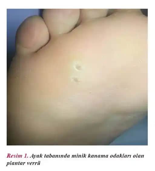 Ayak Tabanı Nasırına Karşı Kapsamlı Rehber: Belirtiler, Tedavi ve Bakım Yöntemleri