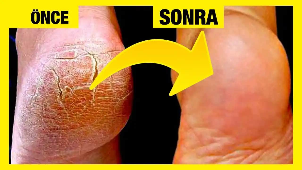 Ayak Topuğu Çatlaklarına Karşı Etkili Bakım Yöntemleri ve Önleyici Çözümler