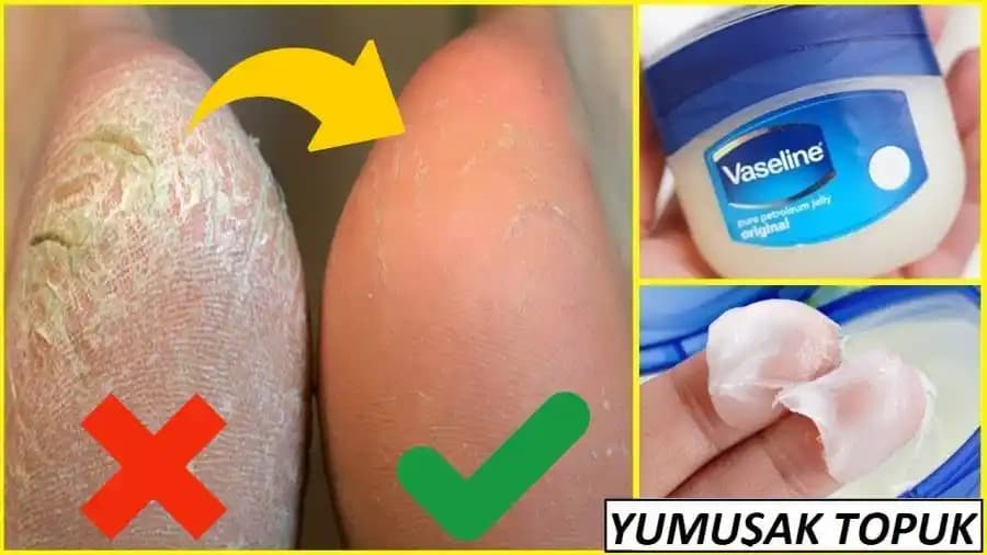 Ayaktaki Çatlaklara Karşı Etkili Çözüm Yöntemleri ve Cilt Sağlığı İpuçları