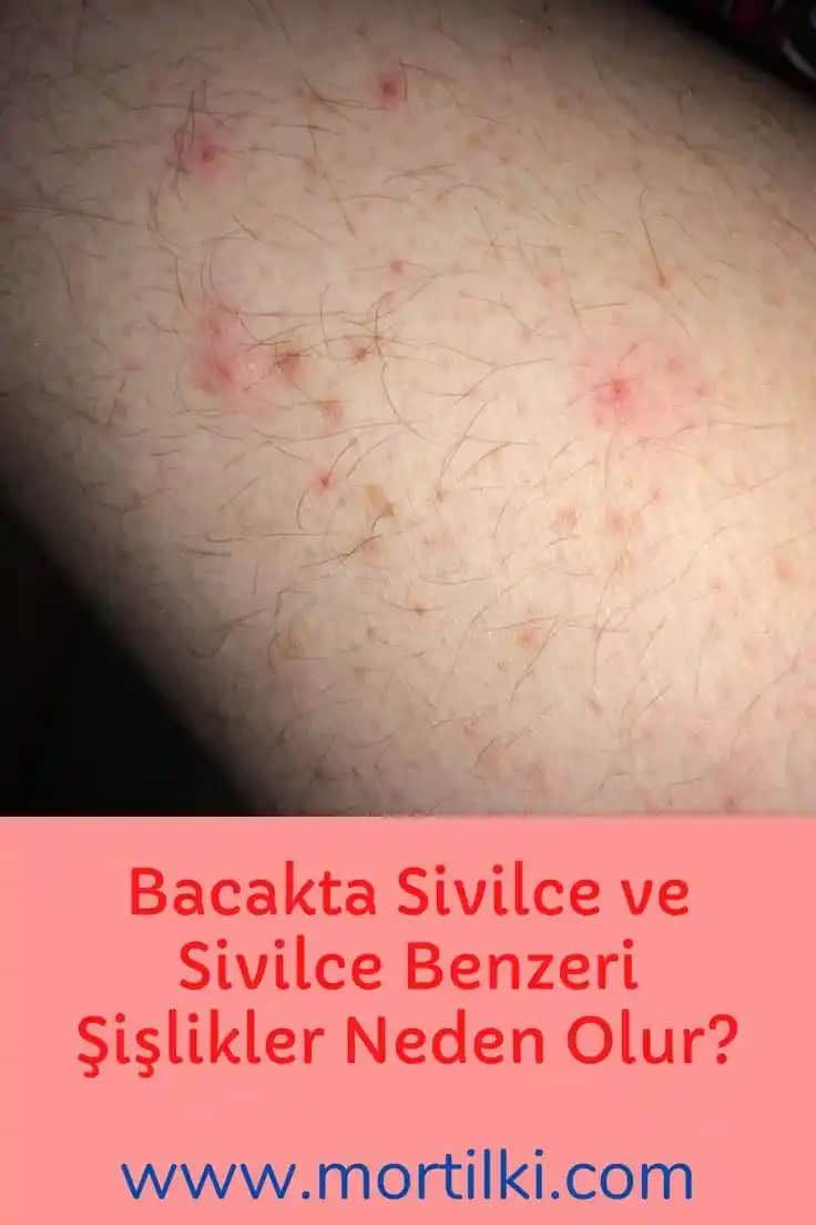 Bacak Arasında Sivilce Nedenleri ve Etkili Önleme Yöntemleri
