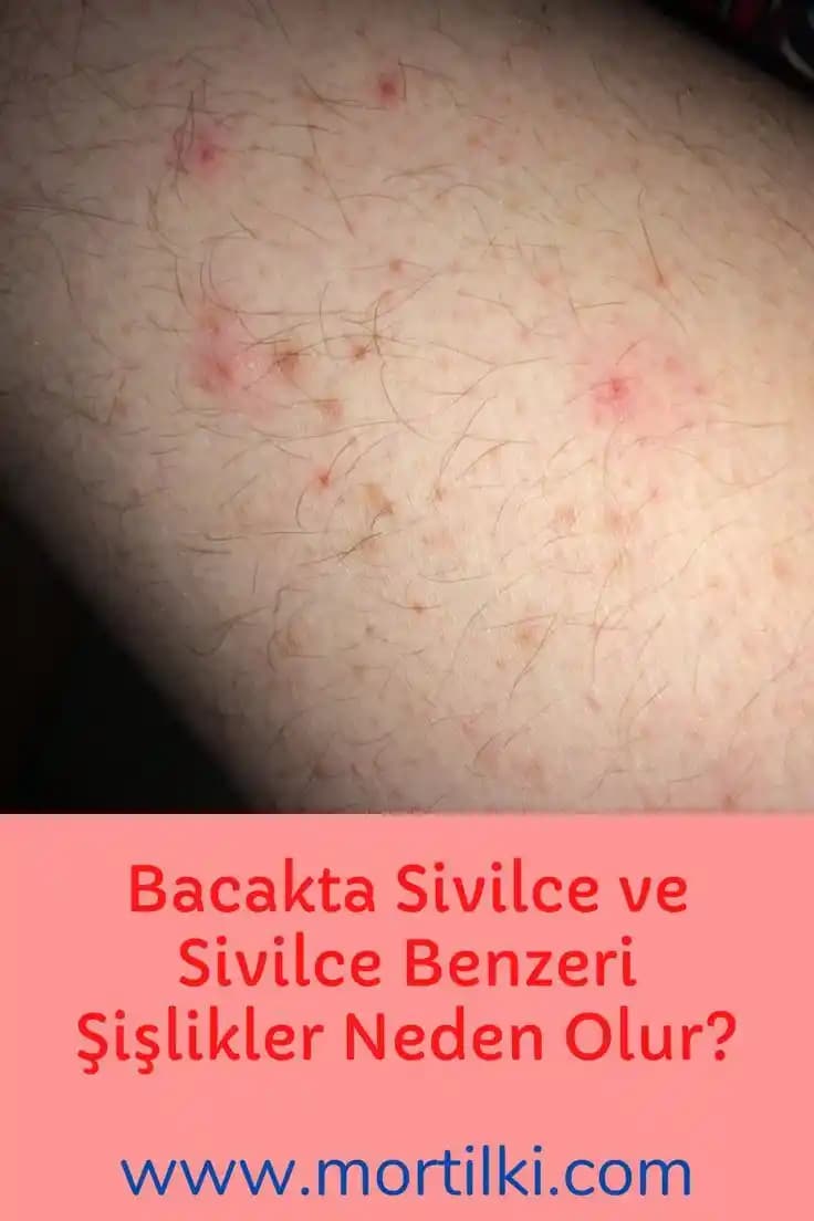 Bacak Arasında Sivilce Nedenleri ve Etkili Önleme Yöntemleri