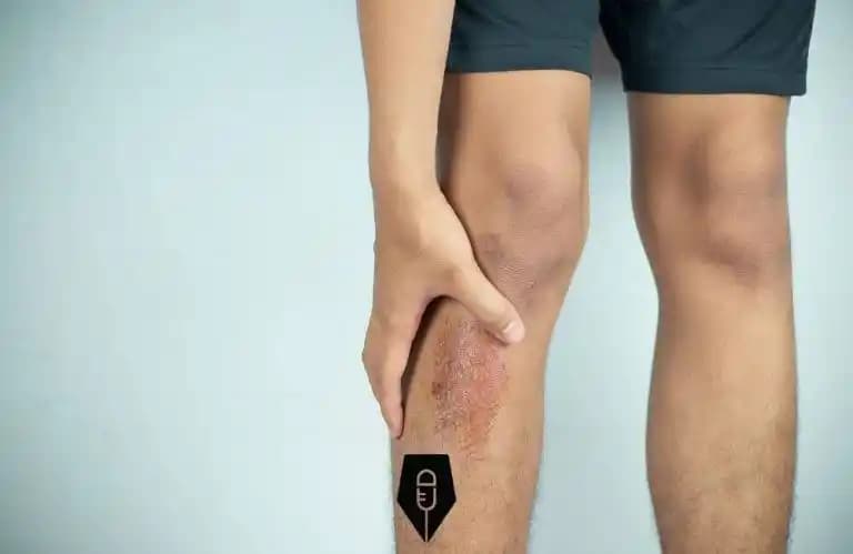 Bacak Yara İzleri Nasıl Geçer Yöntemler ve Tedavi Seçenekleri