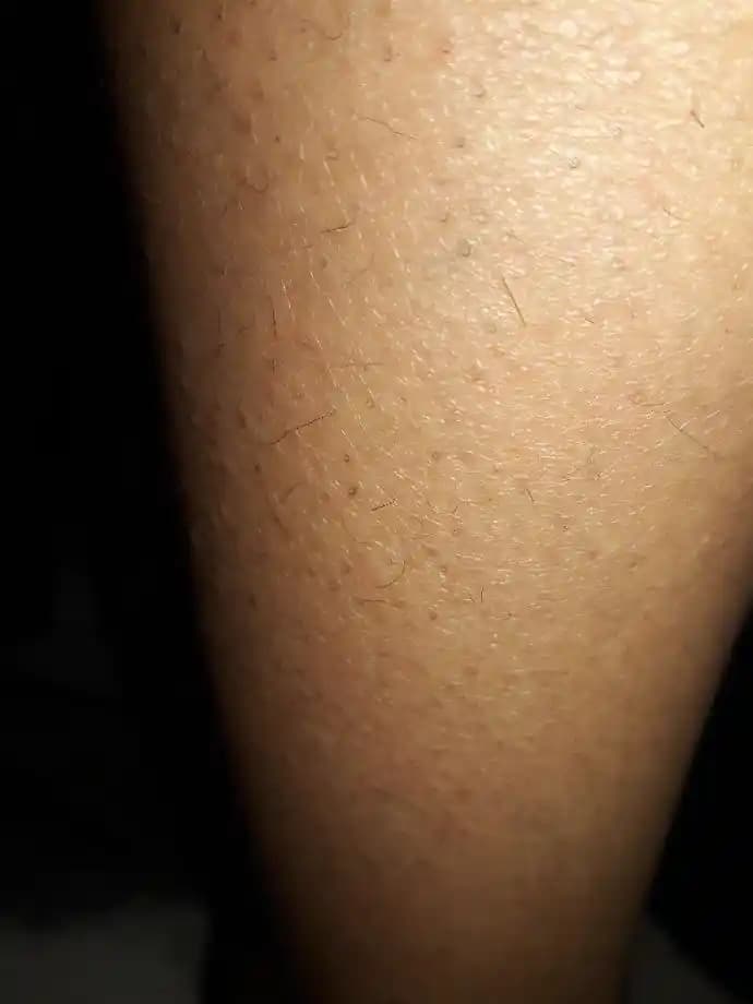 Bacaklarda Kıl Dökülmesi Nedenleri ve Etkili Önleme Yöntemleri Hakkında Bilgi