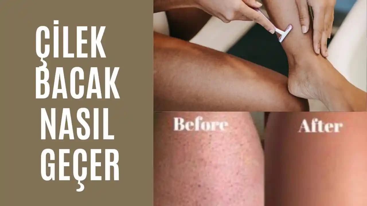 Bacaklardaki Kararmaları Azaltan Etkili ve Doğal Yöntemler Hakkında Bilgi