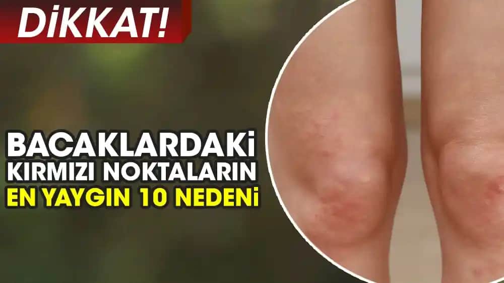 Bacaklardaki Kırmızı Lekelerin Nedenleri ve Etkili Çözüm Yolları Hakkında Kapsamlı Bilgi