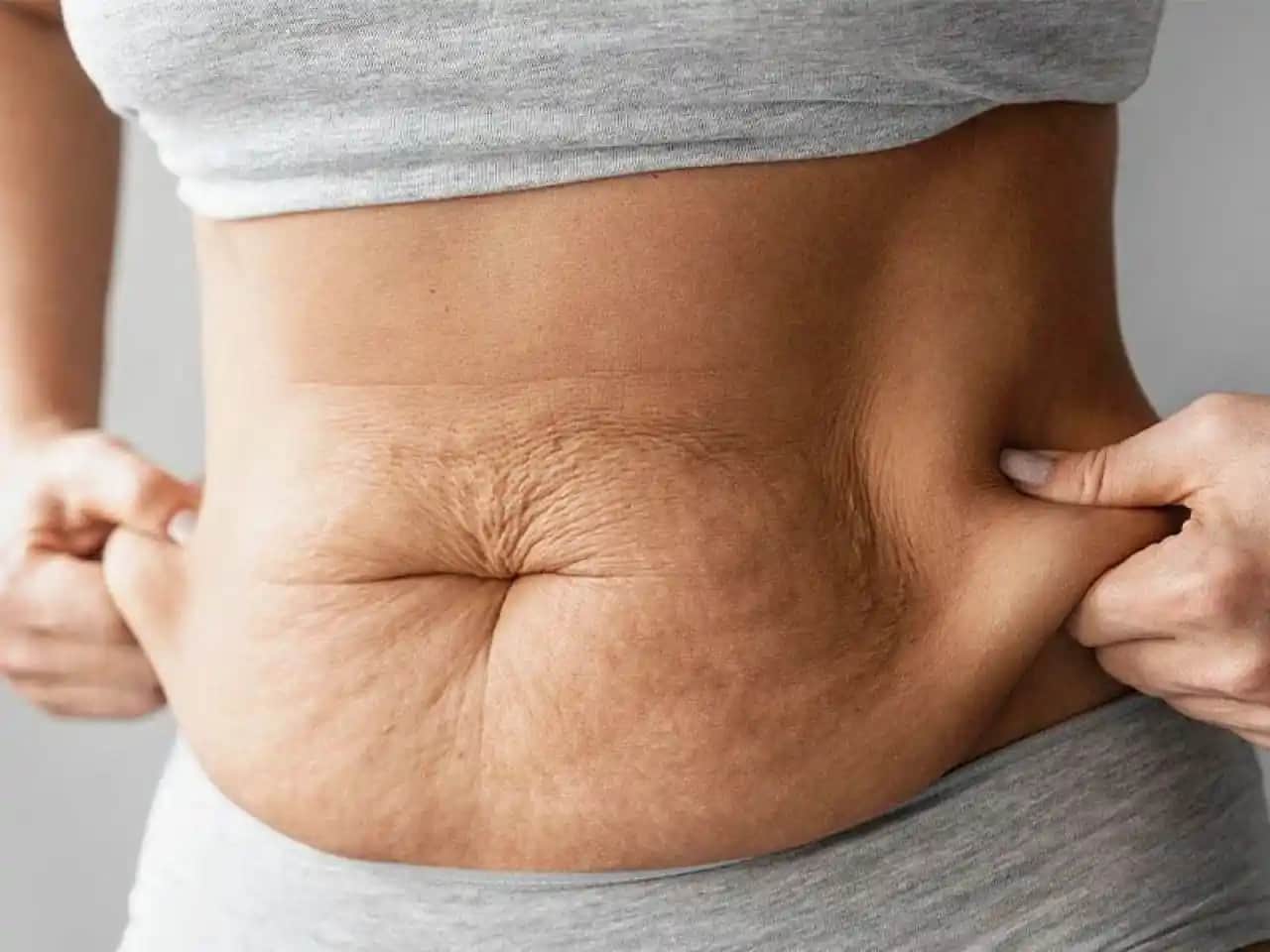 Bacaklardaki Portakal Görünümünü Azaltmak İçin Etkili Yöntemler ve Tedavi Seçenekleri