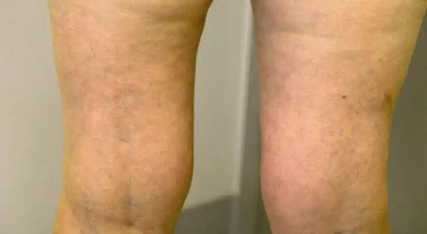Bacaklardaki Renk Eşitsizliği Nedenleri, Belirtileri ve Çözüm Yolları