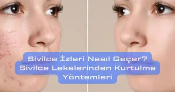 Bacaklardaki Sivilce İzlerinin Giderilmesi İçin Etkili Yöntemler ve Doğal Çözümler