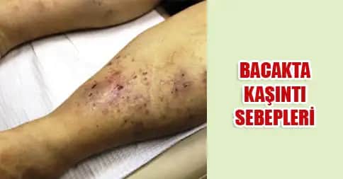 Bacakta Çıkan Yaraların Nedenleri ve Alınabilecek Önlemler Hakkında Bilgilendirici Rehber