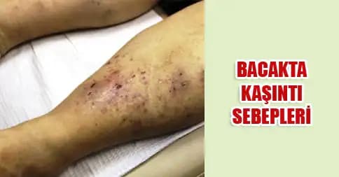 Bacakta Çıkan Yaraların Nedenleri ve Alınabilecek Önlemler Hakkında Bilgilendirici Rehber