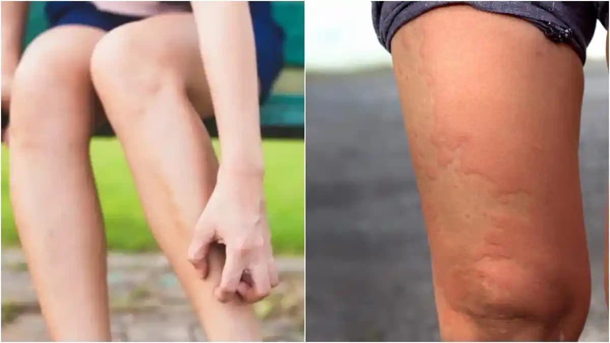 Bacakta Kaşıntılı Yararlar Nedenleri ve Tedavi Yöntemleri Hakkında Kapsamlı Bilgi