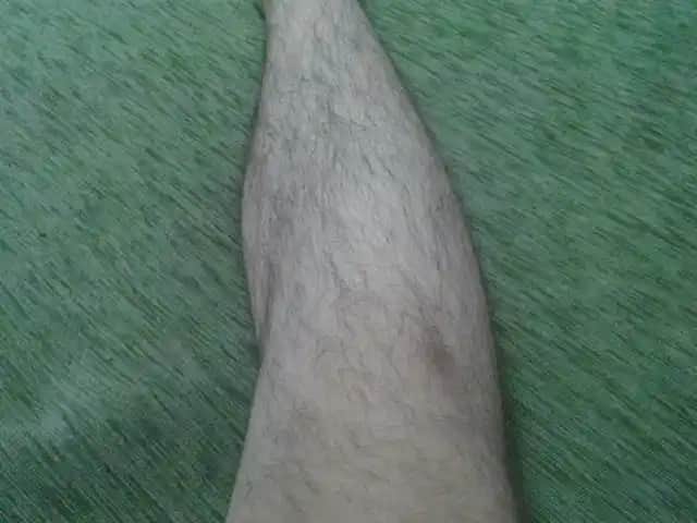 Bacakta Kısmi Kıl Dökülmesi ve Kozmetik Yaklaşımlar Hakkında Detaylı Rehber