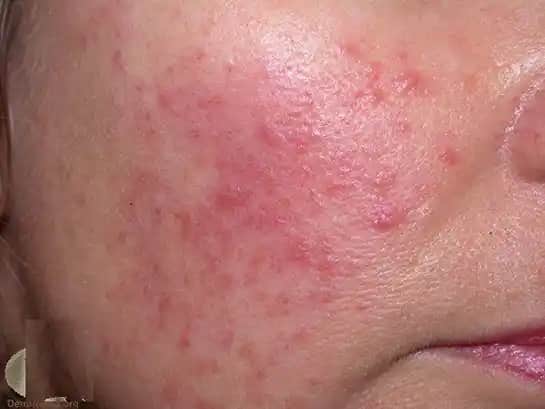 Bacakta Kızarıklık ve Yanma Hissi Nedenleri, Belirtileri ve Çözüm Yolları