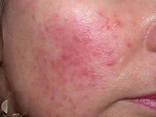 Bacakta Kızarıklık ve Yanma Hissi Nedenleri, Belirtileri ve Çözüm Yolları