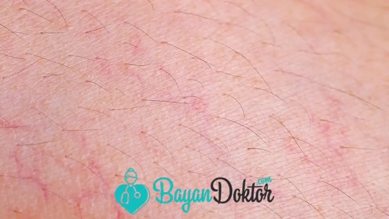 Bacakta Mor Çatlaklar Neden Oluşur ve Etkili Önleme Yöntemleri Nelerdir