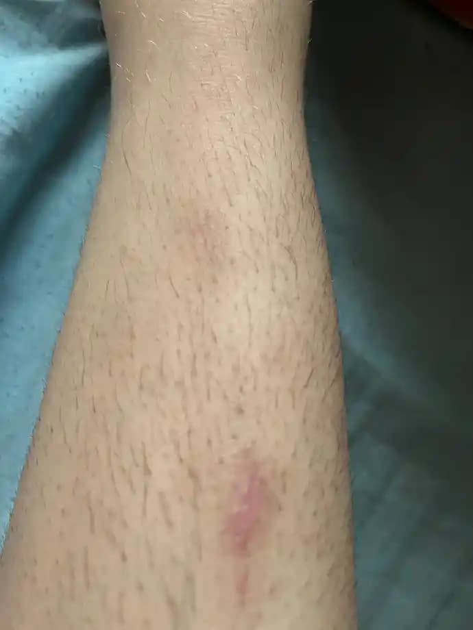 Bacakta Oluşan Yaraların Nedenleri ve İyileşme Sürecine Yönelik Etkili Çözümler