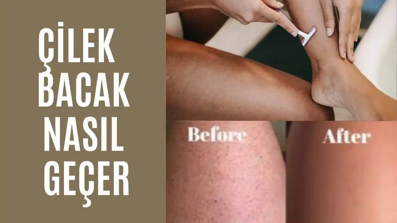 Batık ve Çilek Bacak Nasıl Geçer? Etkili Çözüm Yöntemleri ve Bakım İpuçları