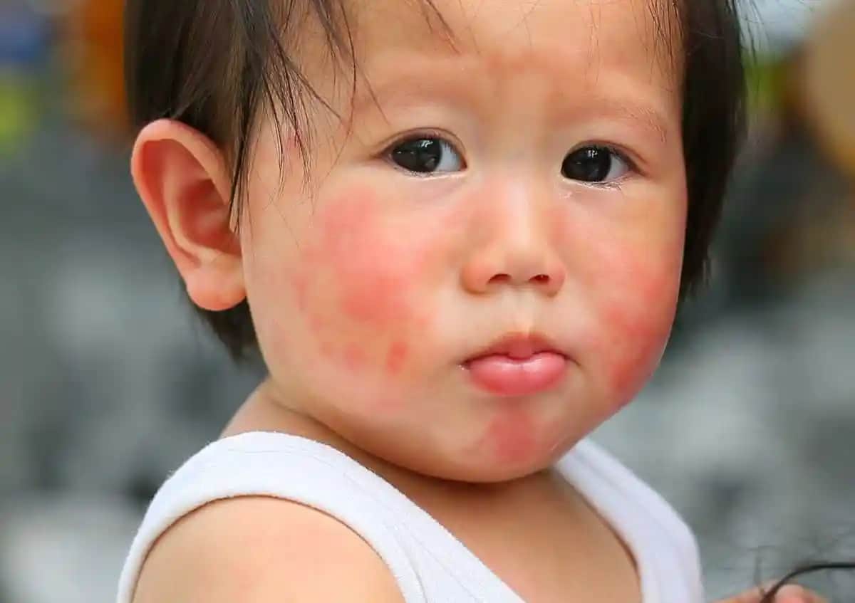 Bebeklerde Aniden Çıkan Kızarıklıkların Nedenleri ve Çözüm Yolları