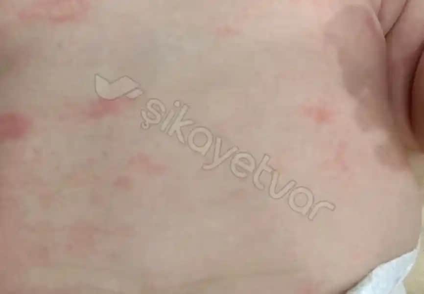 Bebeklerde Bacakta Kabarcıklar Nedenleri Belirtileri ve Tedavi Yöntemleri
