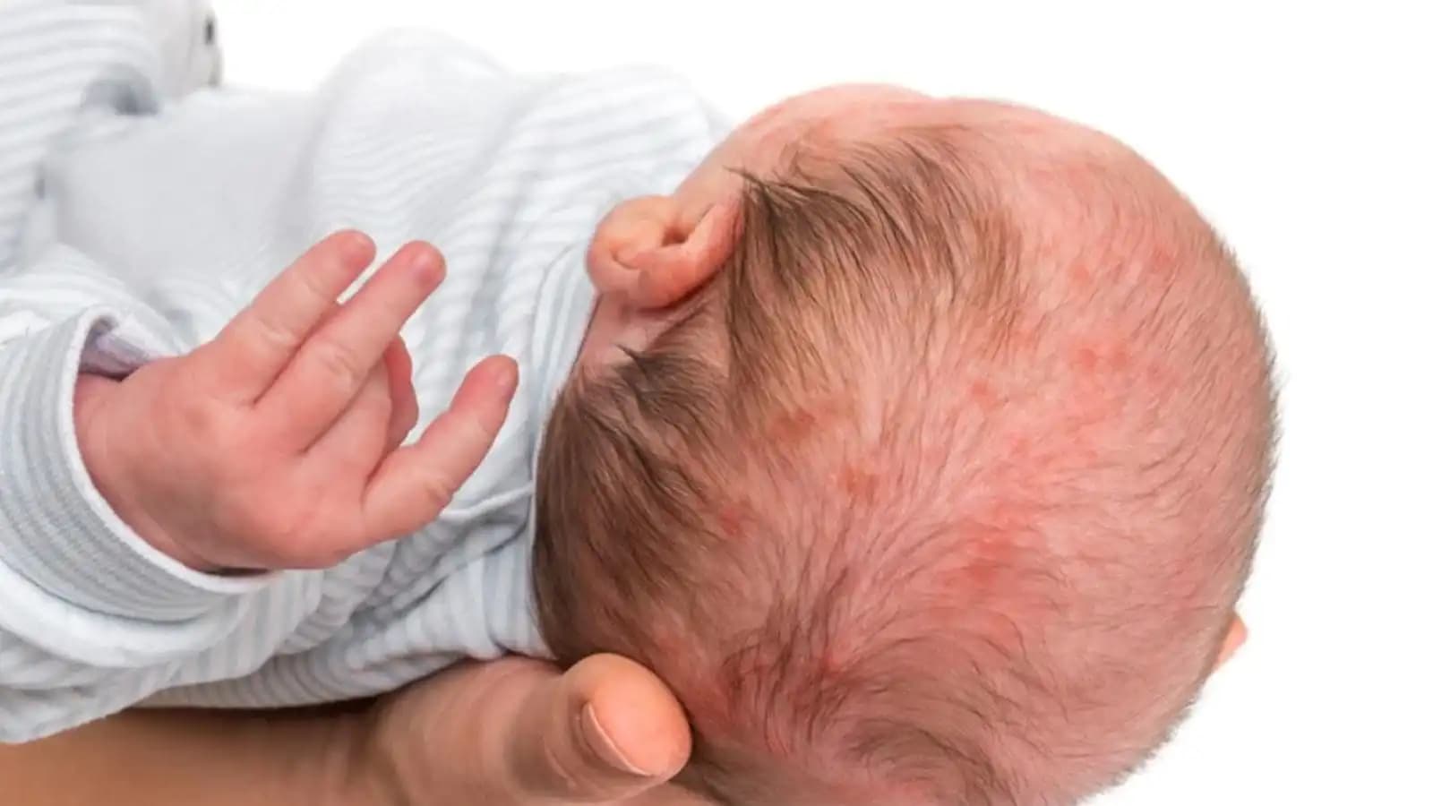 Bebeklerde Boyun Egzaması ve Doğru Kozmetik Bakım Yöntemleri