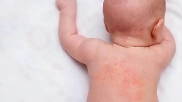 Bebeklerde Boyun Kızarıklığının Nedenleri Belirtileri ve Uygun Bakım Yöntemleri