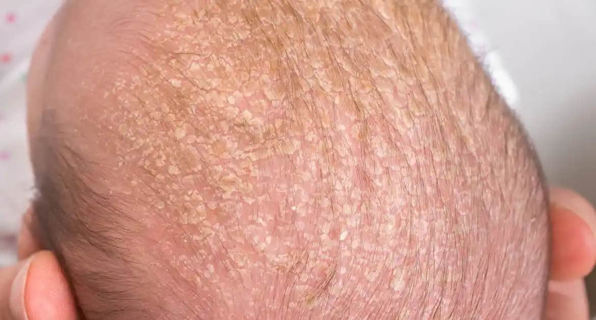 Bebeklerde Cilt Kuruluğu Nedenleri Belirtileri ve Korunma Yöntemleri