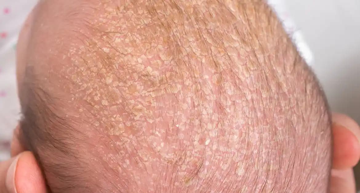 Bebeklerde Cilt Kuruluğu Nedenleri Belirtileri ve Korunma Yöntemleri