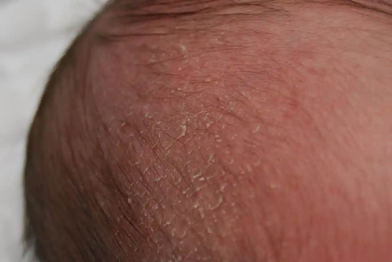 Bebeklerde Kafa Derisinde Kabuklanma Nedenleri ve Etkili Bakım Yöntemleri