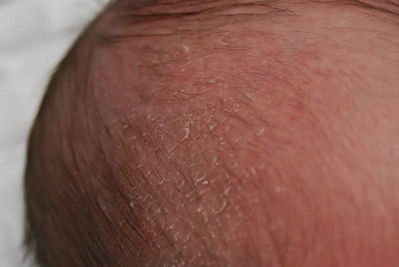 Bebeklerde Kafa Derisinde Kabuklanma Nedenleri ve Etkili Bakım Yöntemleri