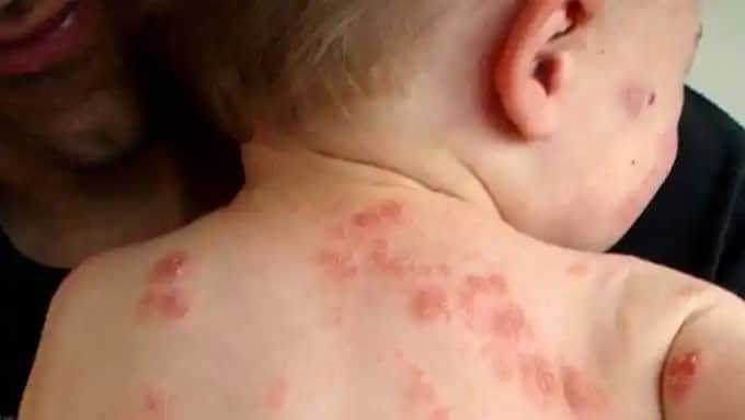 Bebeklerde Sedef Hastalığı: Belirtileri, Tedavi Yöntemleri ve Kozmetik Bakım İpuçları